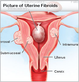 uterine-fibroids-illustration